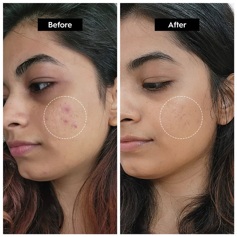 The Ordinary Niacinamide 10% + Zinc 1% Serum - 30ml Homzystore